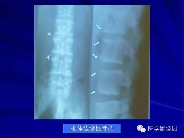 【PPT】脊柱各种征象的介绍