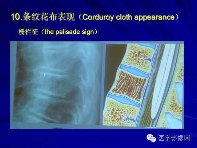 【PPT】脊柱各种征象的介绍