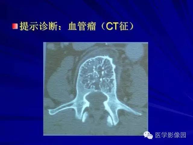 【PPT】脊柱各种征象的介绍