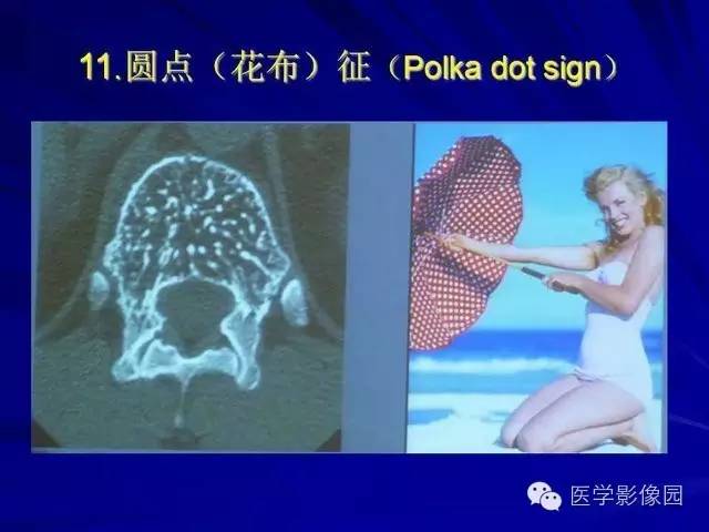 【PPT】脊柱各种征象的介绍