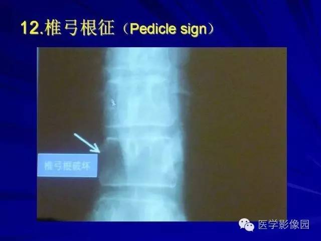 【PPT】脊柱各种征象的介绍