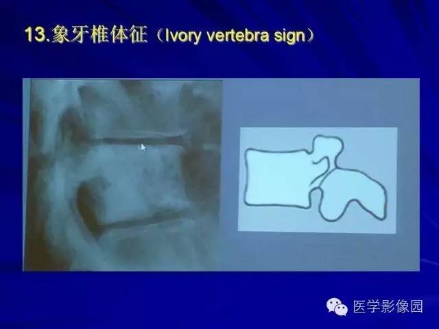 【PPT】脊柱各种征象的介绍