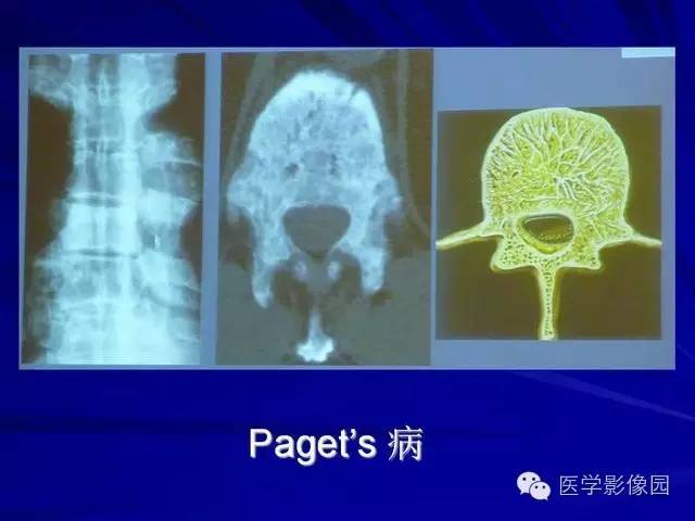 【PPT】脊柱各种征象的介绍