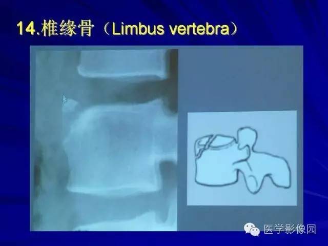 【PPT】脊柱各种征象的介绍
