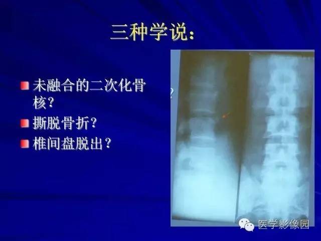 【PPT】脊柱各种征象的介绍