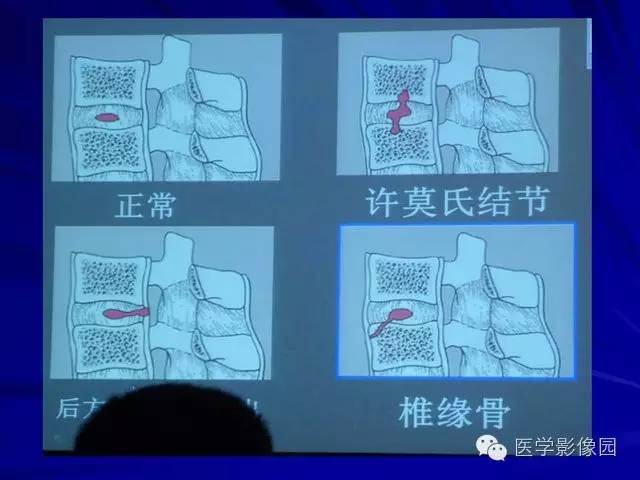 【PPT】脊柱各种征象的介绍