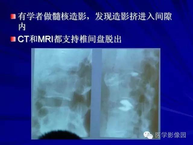 【PPT】脊柱各种征象的介绍