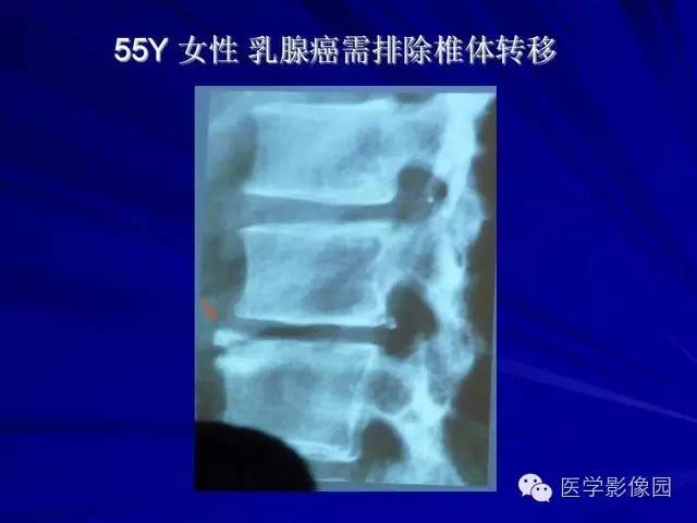 【PPT】脊柱各种征象的介绍