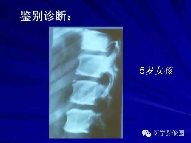 【PPT】脊柱各种征象的介绍
