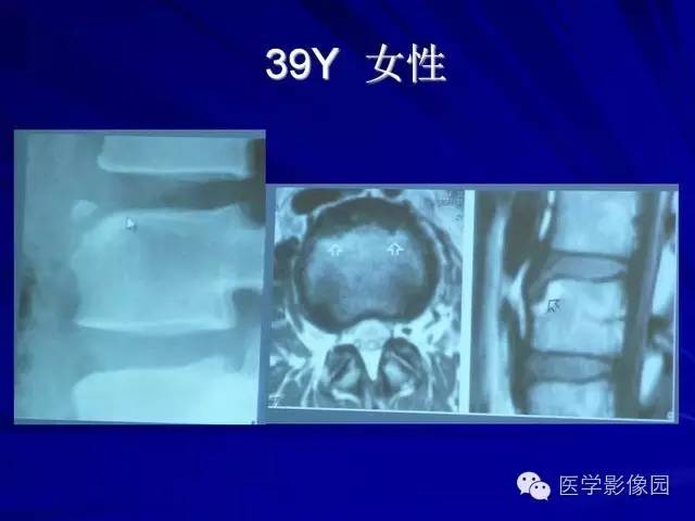 【PPT】脊柱各种征象的介绍