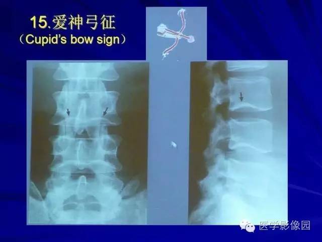 【PPT】脊柱各种征象的介绍