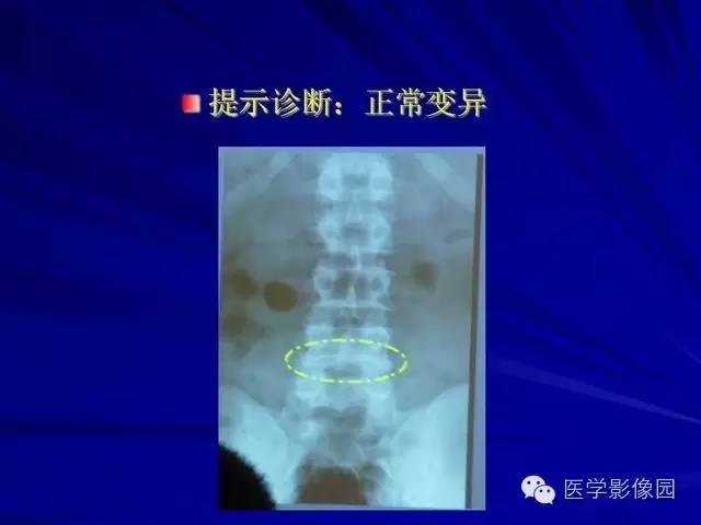 【PPT】脊柱各种征象的介绍