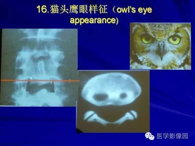 【PPT】脊柱各种征象的介绍