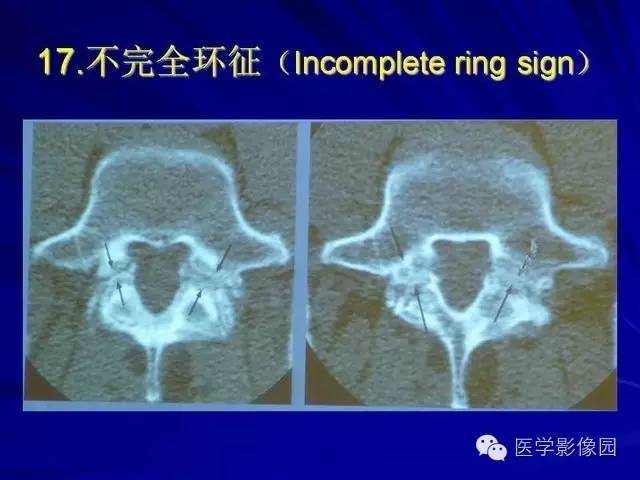 【PPT】脊柱各种征象的介绍