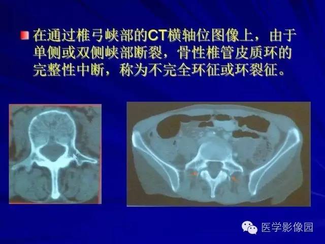 【PPT】脊柱各种征象的介绍