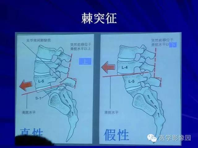 【PPT】脊柱各种征象的介绍