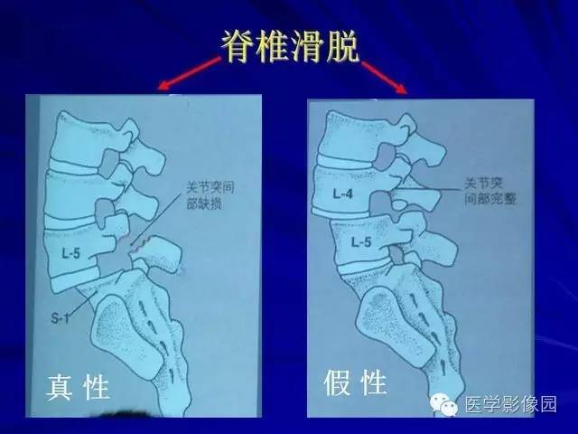 【PPT】脊柱各种征象的介绍