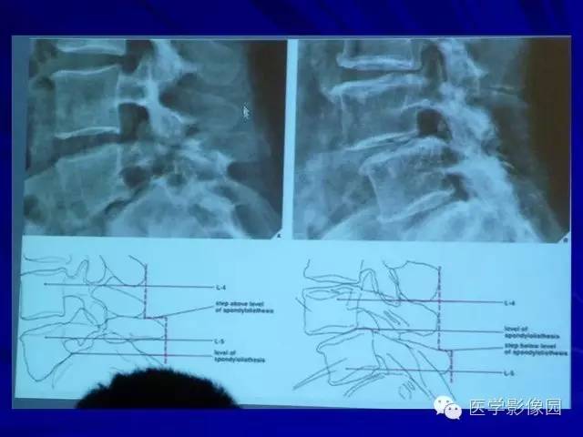 【PPT】脊柱各种征象的介绍