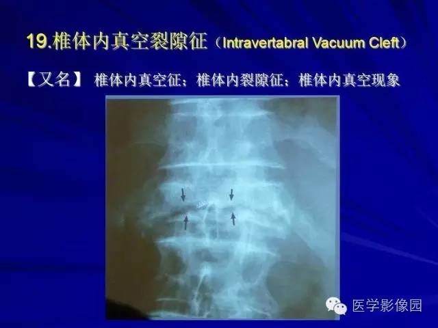 【PPT】脊柱各种征象的介绍