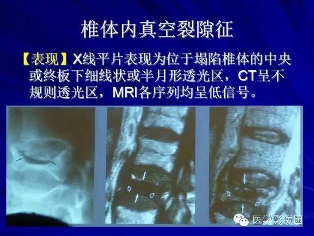 【PPT】脊柱各种征象的介绍