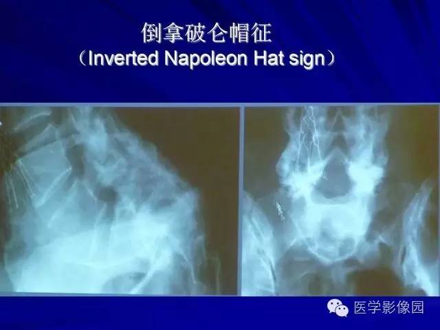 【PPT】脊柱各种征象的介绍