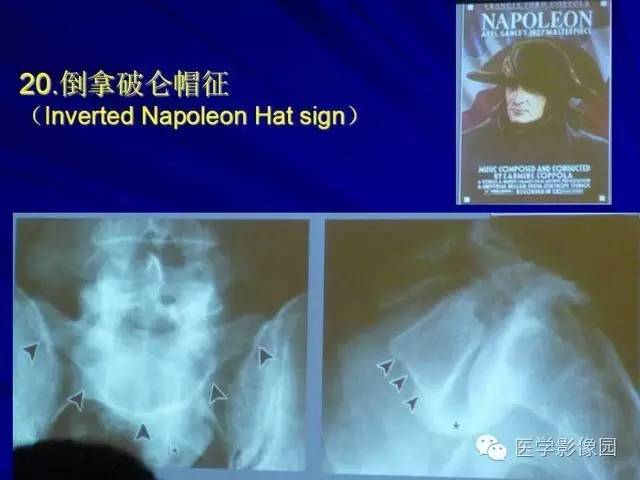 【PPT】脊柱各种征象的介绍