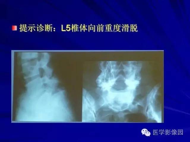 【PPT】脊柱各种征象的介绍