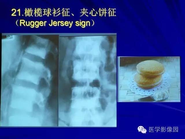 【PPT】脊柱各种征象的介绍