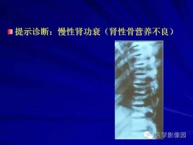 【PPT】脊柱各种征象的介绍