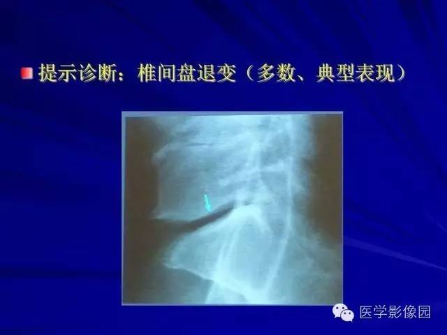【PPT】脊柱各种征象的介绍