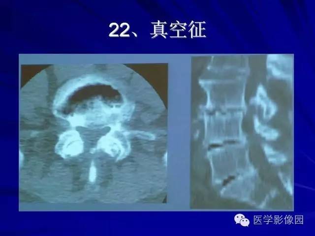 【PPT】脊柱各种征象的介绍