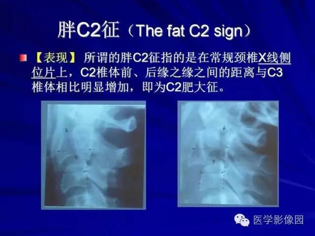【PPT】脊柱各种征象的介绍