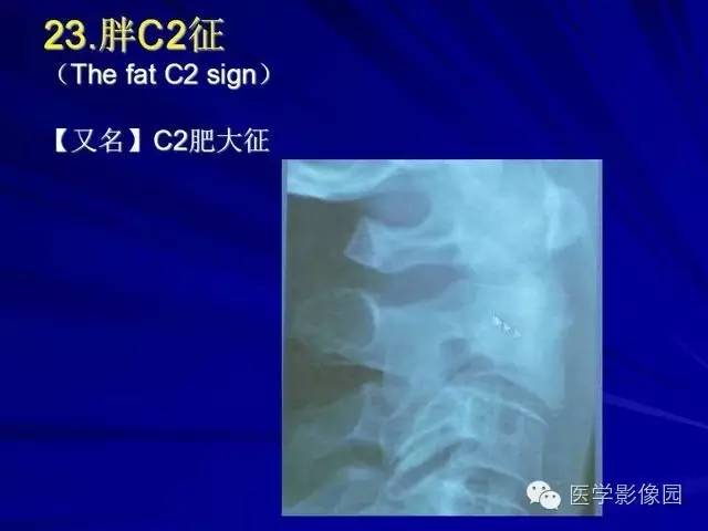 【PPT】脊柱各种征象的介绍