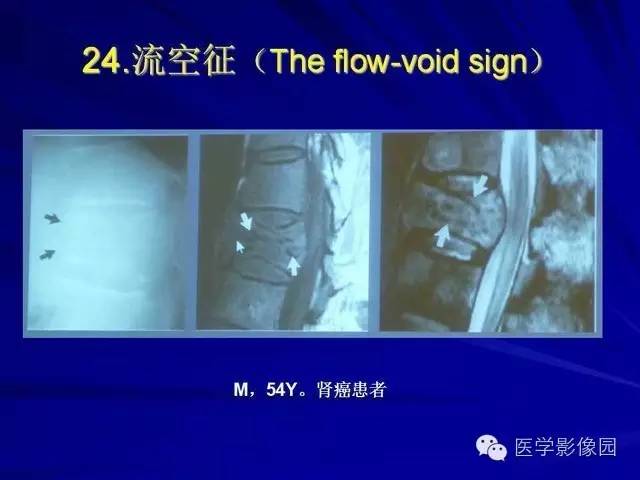 【PPT】脊柱各种征象的介绍