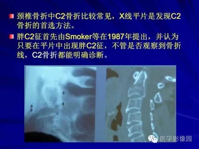 【PPT】脊柱各种征象的介绍