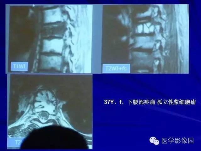 【PPT】脊柱各种征象的介绍