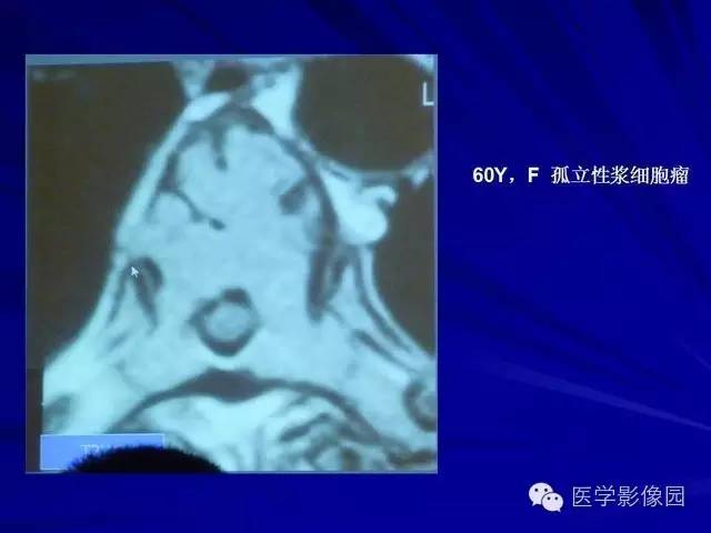 【PPT】脊柱各种征象的介绍