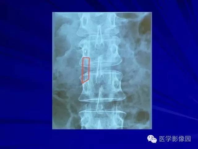 【PPT】脊柱各种征象的介绍