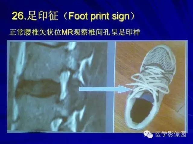 【PPT】脊柱各种征象的介绍