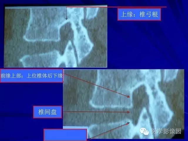 【PPT】脊柱各种征象的介绍