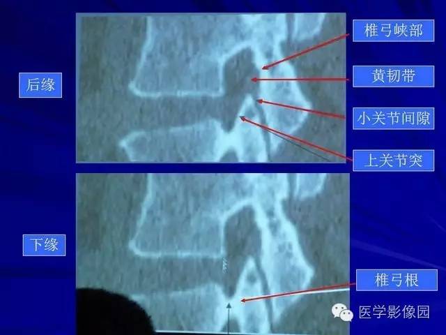 【PPT】脊柱各种征象的介绍