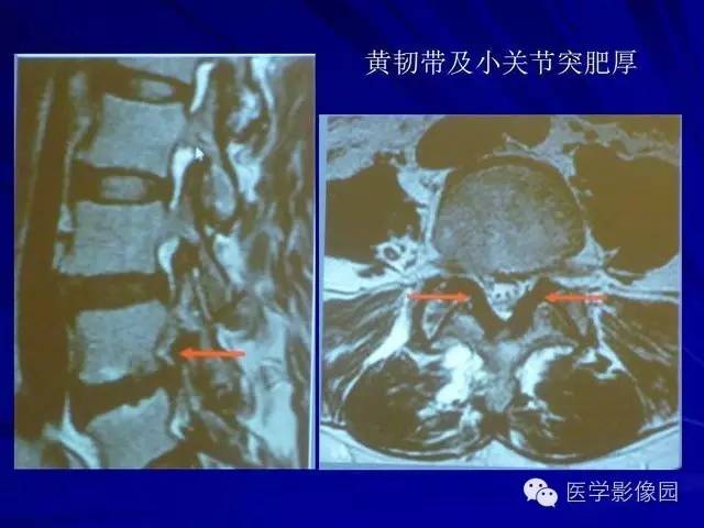 【PPT】脊柱各种征象的介绍