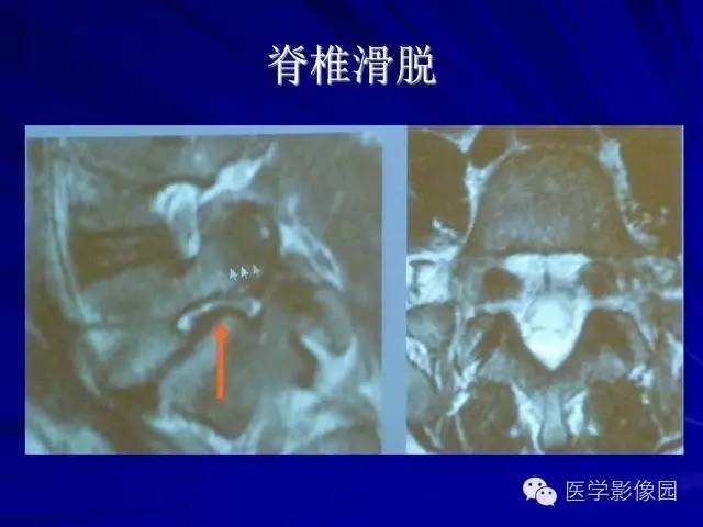 【PPT】脊柱各种征象的介绍