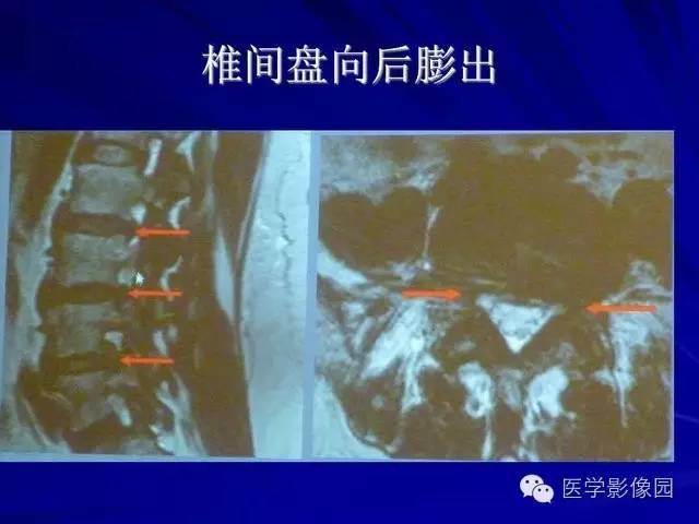 【PPT】脊柱各种征象的介绍
