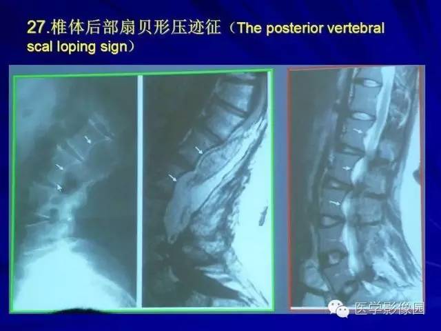 【PPT】脊柱各种征象的介绍