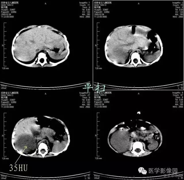【病例】先天性中胚叶肾瘤1例CT影像表现