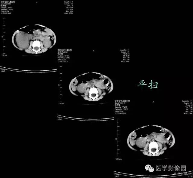 【病例】先天性中胚叶肾瘤1例CT影像表现 【病例】先天性中胚叶肾瘤1例CT影像表现