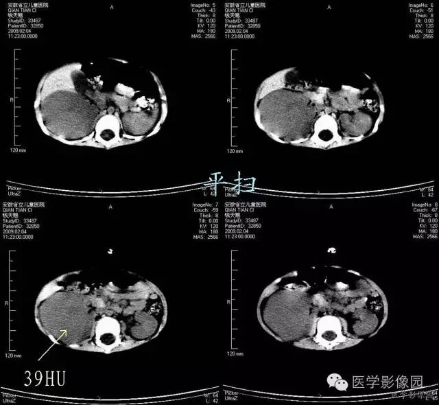 【病例】先天性中胚叶肾瘤1例CT影像表现 【病例】先天性中胚叶肾瘤1例CT影像表现
