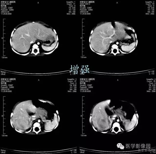 【病例】先天性中胚叶肾瘤1例CT影像表现 【病例】先天性中胚叶肾瘤1例CT影像表现