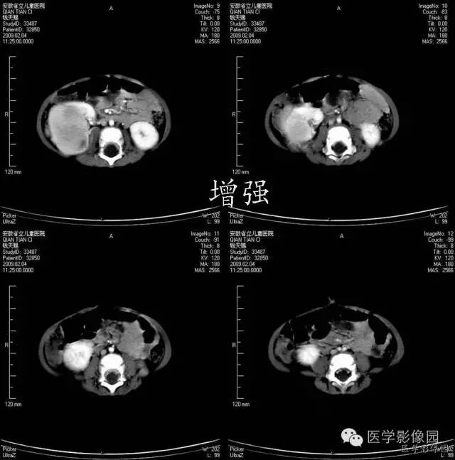 【病例】先天性中胚叶肾瘤1例CT影像表现 【病例】先天性中胚叶肾瘤1例CT影像表现